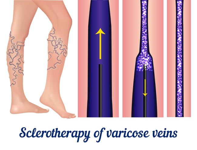 varicose veins: Are you 6-feet tall? Watch out for varicose veins