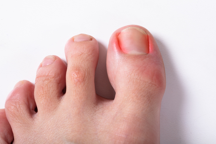 Ingrown Toenail Treatment - How to Remove It and Prevent Infections