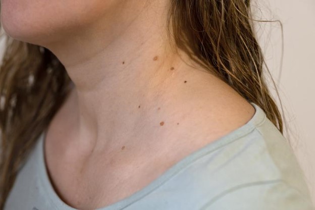 Skin Tags Treatment Options And Causes In Salt Lake City
