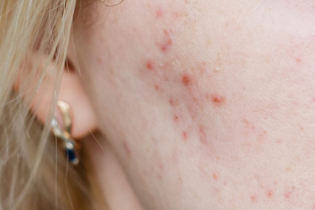 A close up of a persons face with acne.